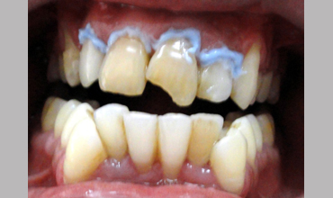 Root canal treatment in Anand
                        